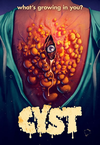 Cyst